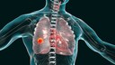 Diet has an influence on lung cancer
