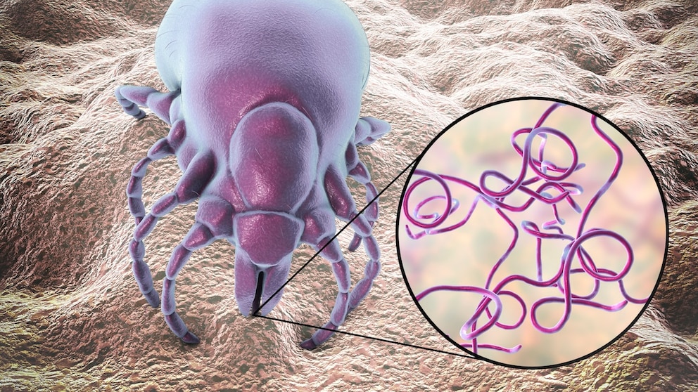 Lyme disease can be transmitted by ticks