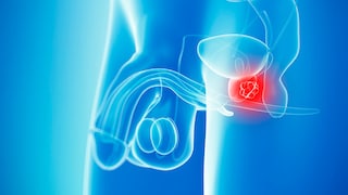 Illustration prostate cancer