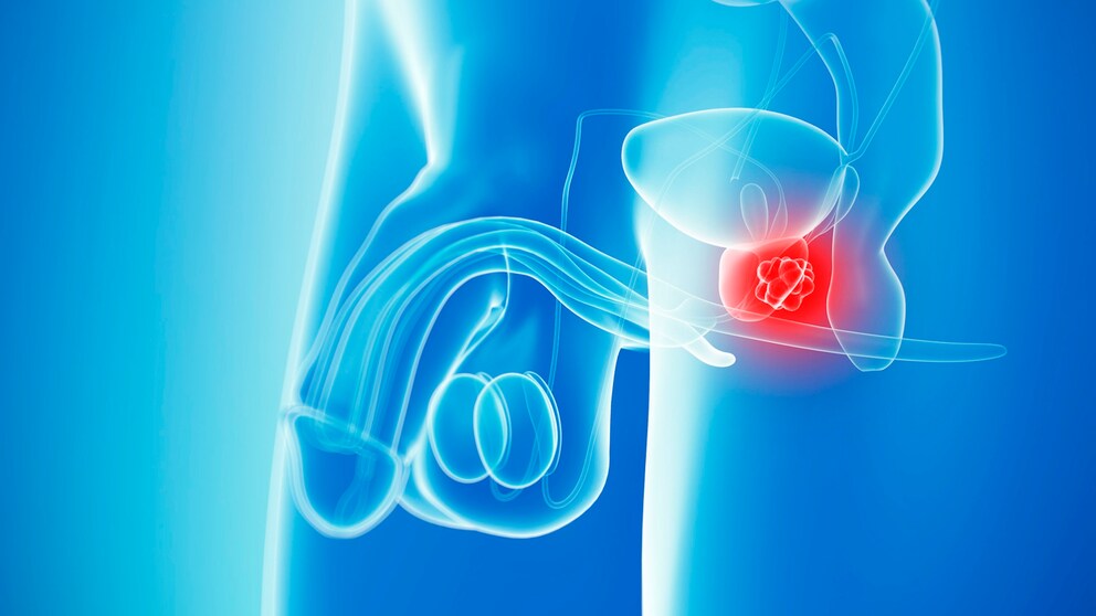 Illustration prostate cancer