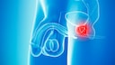 Illustration prostate cancer