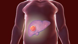 Statins are said to reduce the risk of liver cancer in people with pre-existing liver disease