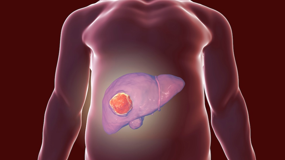 Statins are said to reduce the risk of liver cancer in people with pre-existing liver disease