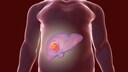 Statins are said to reduce the risk of liver cancer in people with pre-existing liver disease