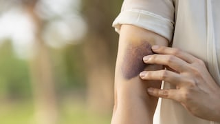 Hemophilia is a bleeding disorder.