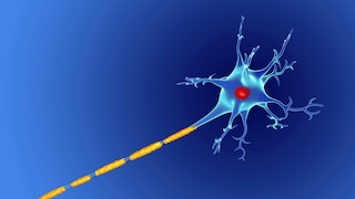 Damaged nerve, as is typical in MS
