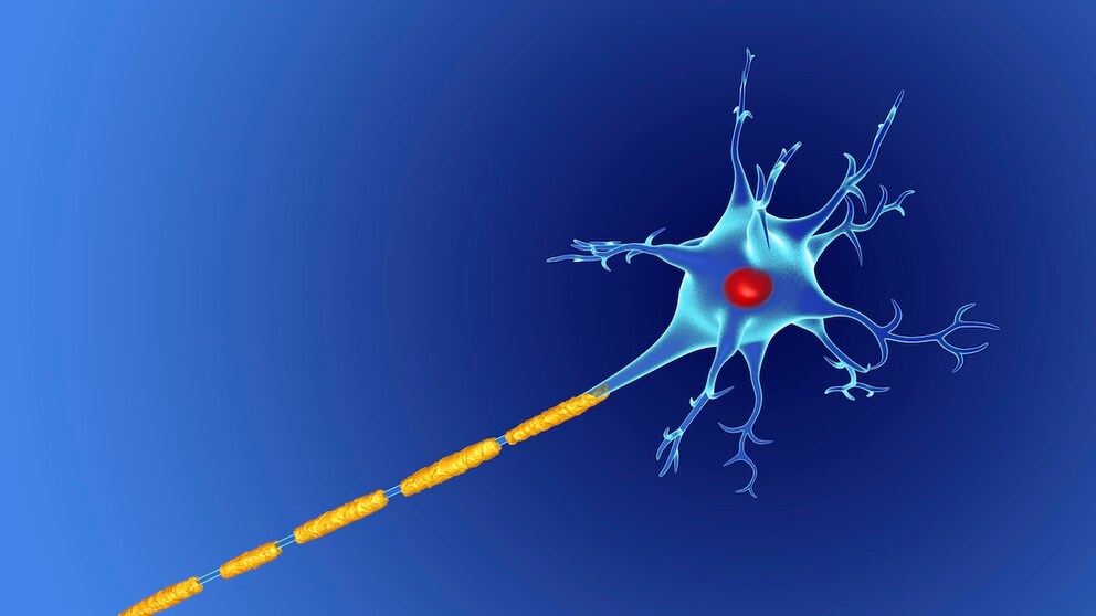 Damaged nerve, as is typical in MS