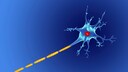 Damaged nerve, as is typical in MS