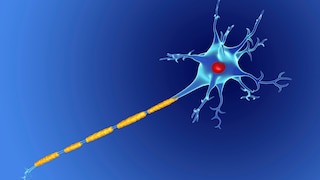 Damaged nerve, as is typical in MS