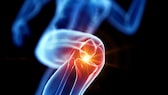Runner's knee