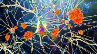 Study Finds Sitting May Contribute to Alzheimer's