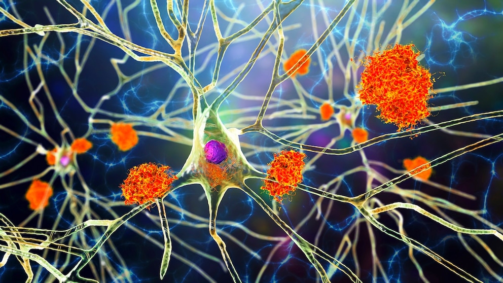 Study Finds Sitting May Contribute to Alzheimer's