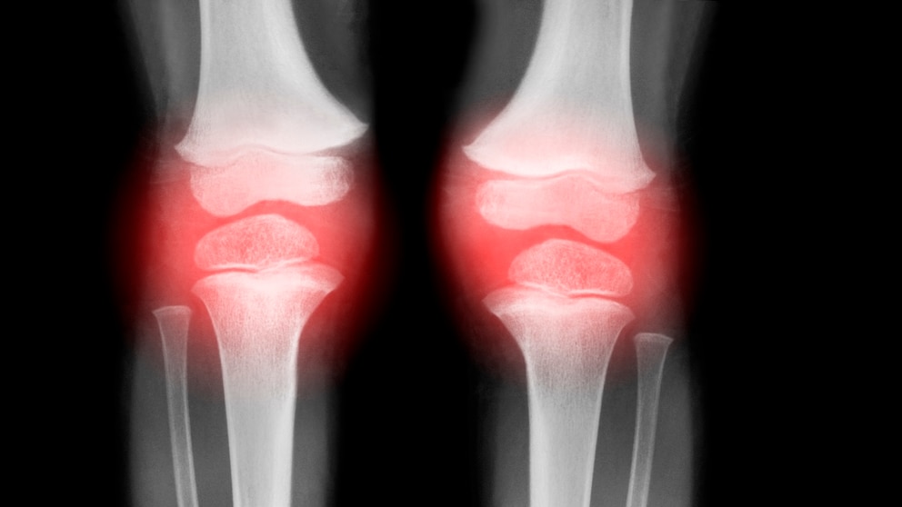 Proper Nutrition Can Affect the Course of Osteoarthritis