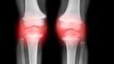 Proper Nutrition Can Affect the Course of Osteoarthritis
