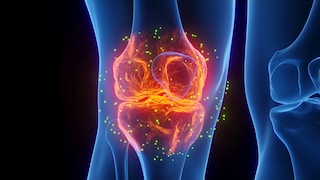 Osteoarthritis