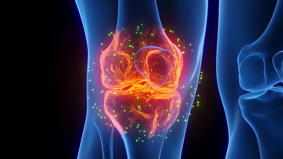 Osteoarthritis