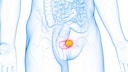 Certain Symptoms May Indicate Bladder Cancer