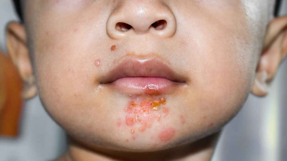 Highly contagious skin infection that can itch and cause pain