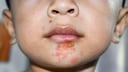 Highly contagious skin infection that can itch and cause pain
