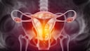Ovarian cancer is a malignant tumor disease that forms in the ovaries.