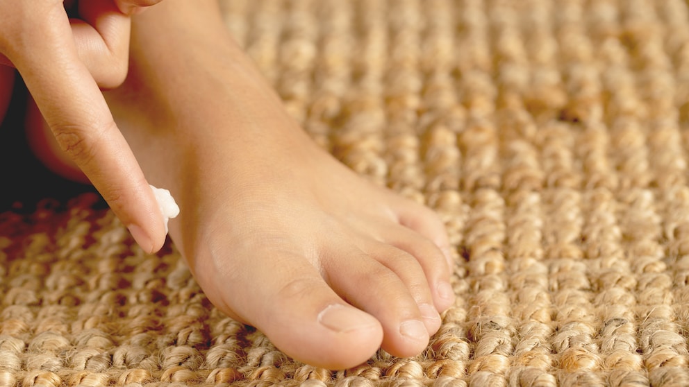 Athlete's foot can develop through small cracks in the skin when the foot is exposed to a lot of moisture.
