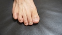 Nail fungus can occur on both hands and feet. Treatment can take several months.