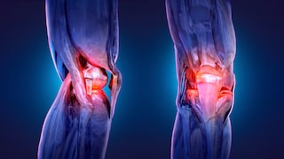 Bowlegs and Osteoarthritis