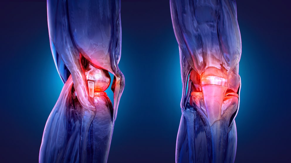 Bowlegs and Osteoarthritis