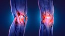 Bowlegs and Osteoarthritis