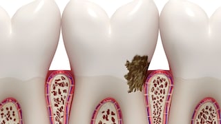 Removing tartar is important