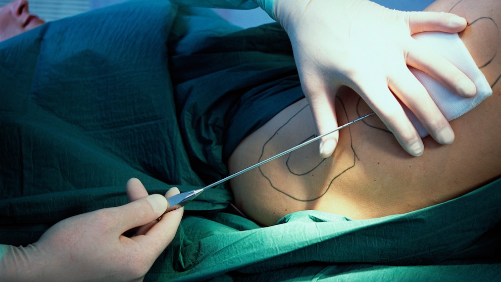 Lipedema can cause significant pain and is often misdiagnosed; now, health insurance covers liposuction.