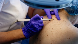 Skin Cancer Herpes