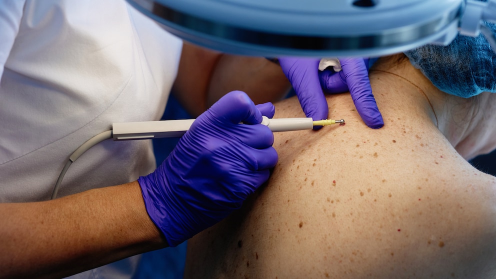 Skin Cancer Herpes