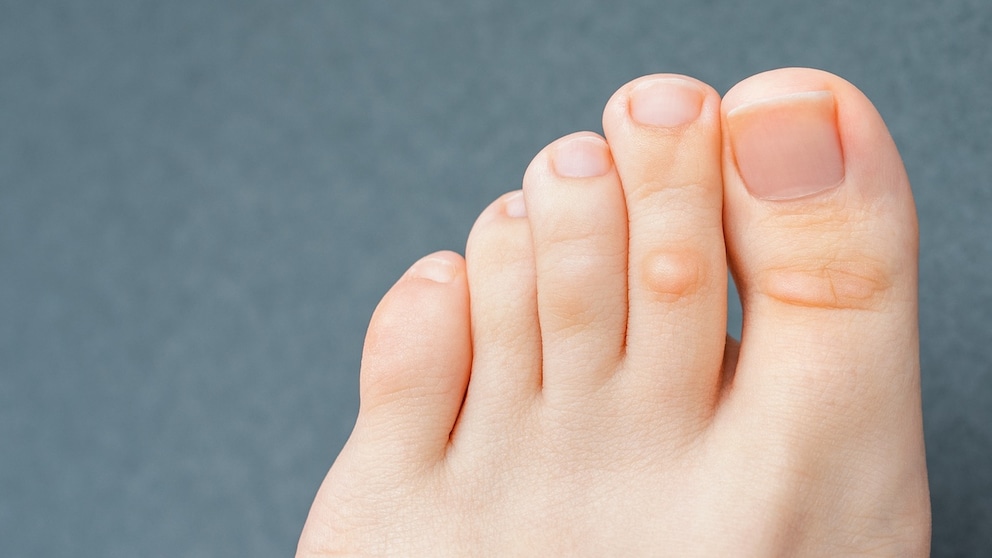 Corns are often mistaken for warts, but they require different treatment.