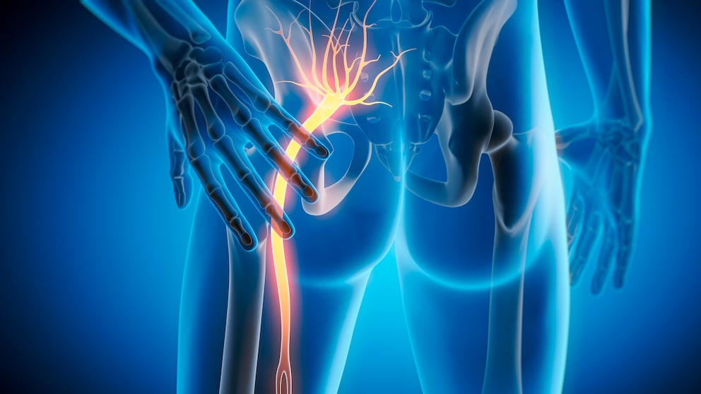 Grandma's remedies, stretching exercises, and walks can often sufficiently soothe sciatica.