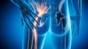 Grandma's remedies, stretching exercises, and walks can often sufficiently soothe sciatica.