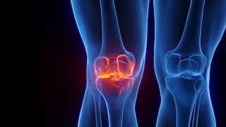 Bursitis, also known as inflammation of the bursae, causes severe joint pain.