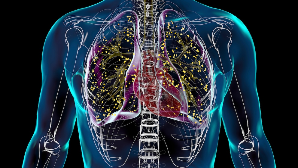 Tuberculosis has become rare in Germany, but the numbers are rising. The outcome of the disease is particularly life-threatening.