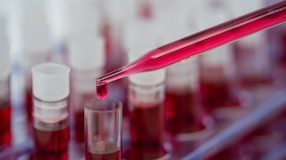 Abnormalities in the Blood of Women With Alzheimer's