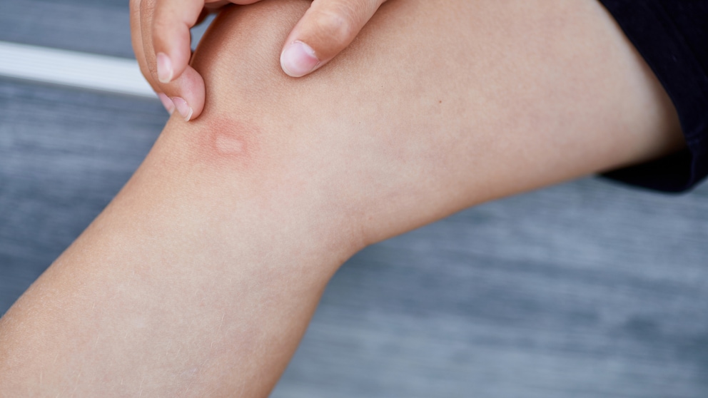 Whether home remedies or natural aids—there are several options that can temporarily relieve the itch of a mosquito bite.
