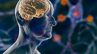 There are numerous causes of dementia—Alzheimer's is one of them.