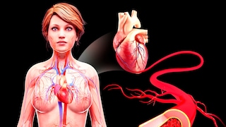 Heart Attack in Women