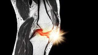 A meniscus tear often occurs during sports or manual labor.