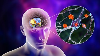 Huntington's Disease