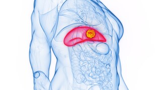 Detecting Liver Cancer Early: Symptoms, Risks, and Treatments