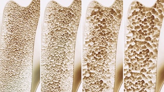 Changes in Bone Structure in Osteoporosis