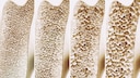 Changes in Bone Structure in Osteoporosis