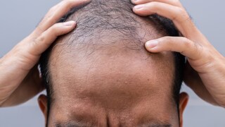 A previously unknown cause of hair loss has been identified.