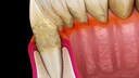Periodontitis