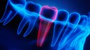 Dental Implant